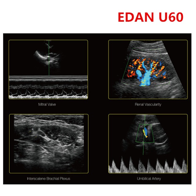 EDAN U60 Portable Ultrasound Machine - Cardiac Images